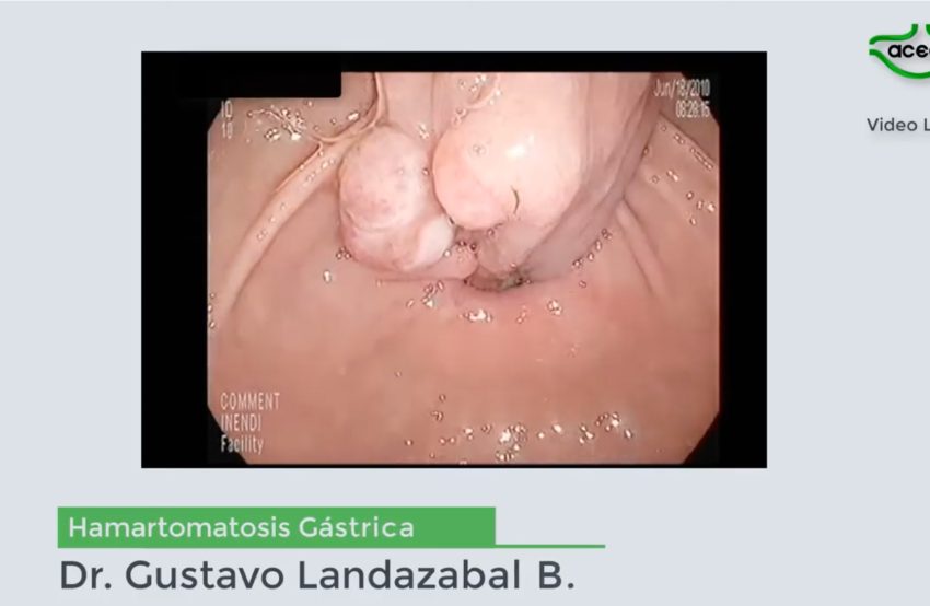  Hamartomas gástricos con polipectomia – Dr. Gustavo Landazabal