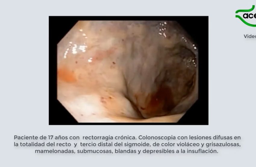  Hemangioma Cavernoso Rectal