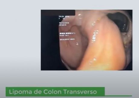  Lipoma Colon Transverso. Dr. Alberto Ángel Pinzón.