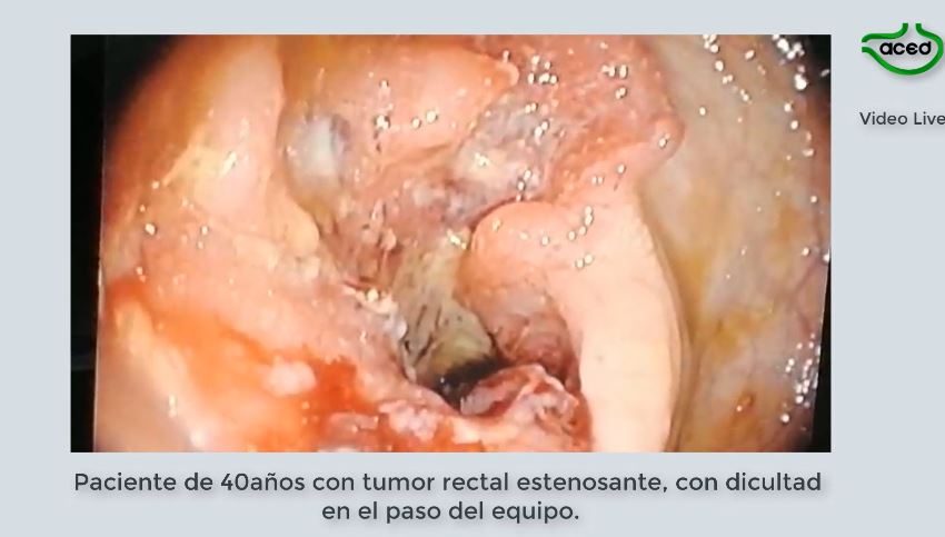  Carcinoma estenosante Rectal