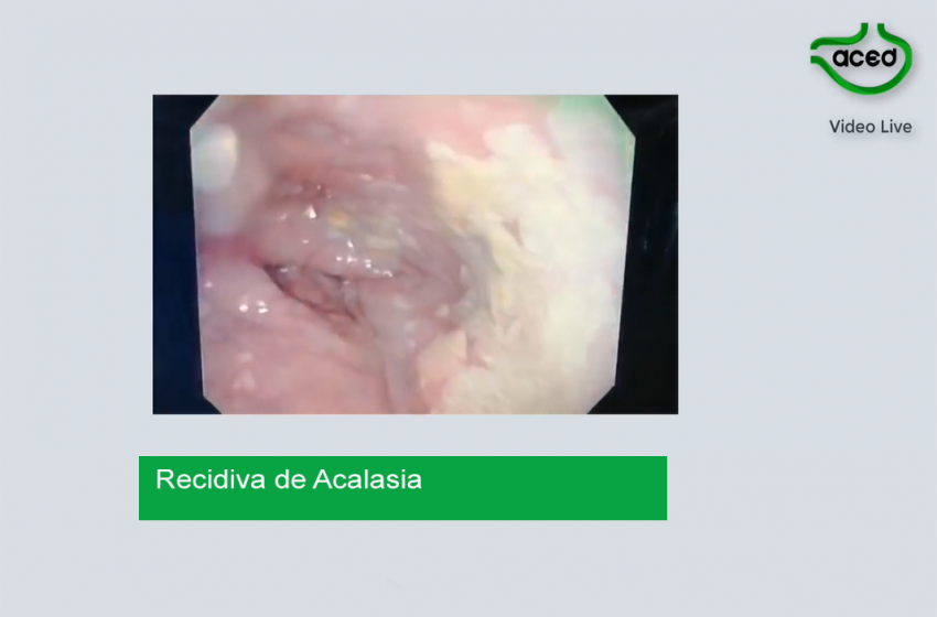  Acalasia Recidivante. Dr. Camilo Blanco A.