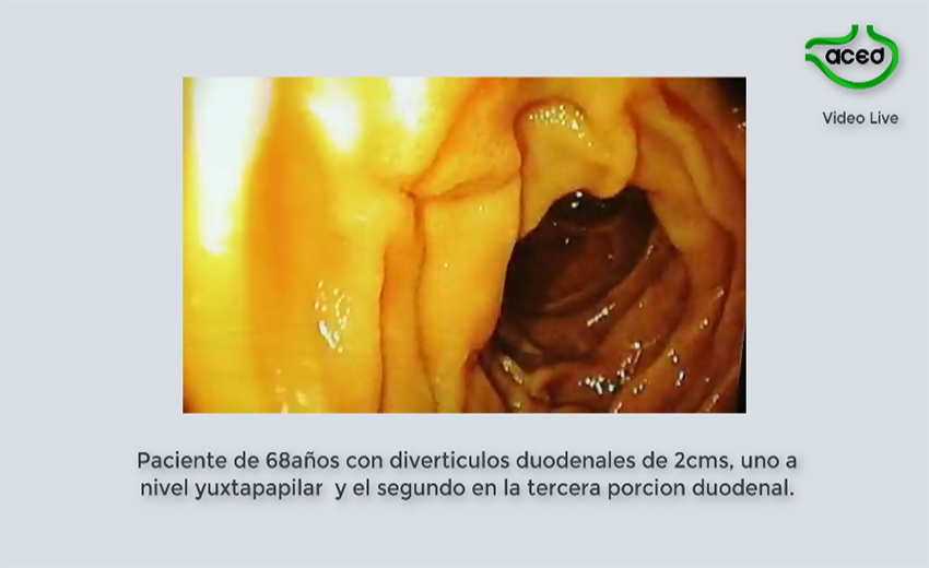  Divertículos Duodenales. Dr. Camilo Blanco A.