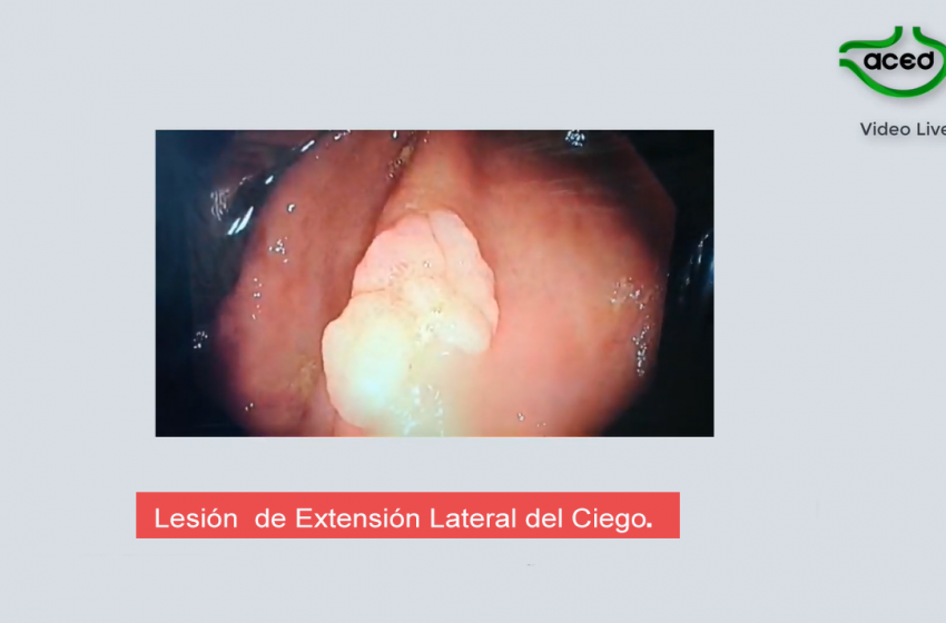  Lesión de Extensión Lateral del Ciego. Dr. Camilo Blanco A.