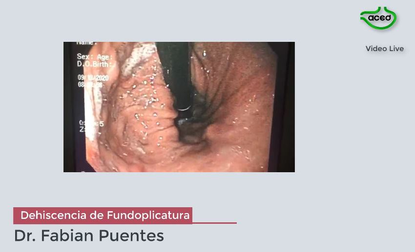  Dehiscencia de Fundoplicatura de Nissen. Dr. Fabian Puentes.