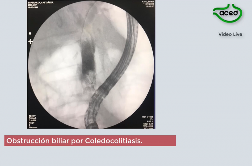  Obstrucción biliar por coledocolitiasis. Litotripsia con Spyglass.