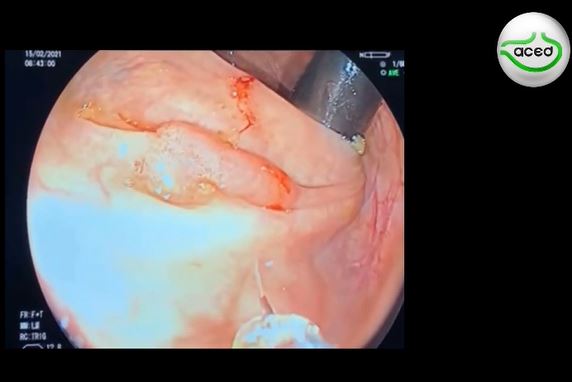  Mucosectomia de lesión plana del colon ascendente en retrovisión – Dr. Arecio Peñaloza